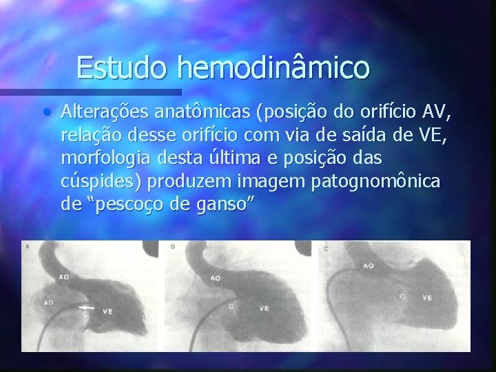 Estudo hemodinâmico • Alterações anatômicas (posição do orifício AV, relação desse orifício com via