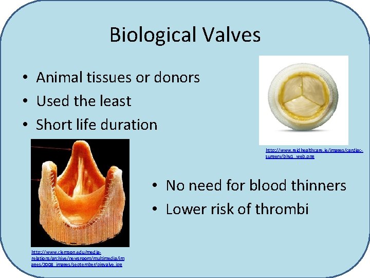 Biological Valves • Animal tissues or donors • Used the least • Short life