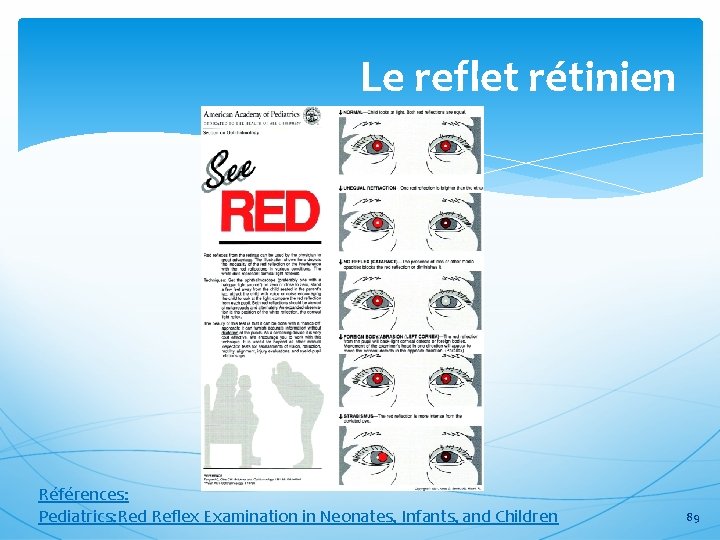 Le reflet rétinien Références: Pediatrics: Red Reflex Examination in Neonates, Infants, and Children 89