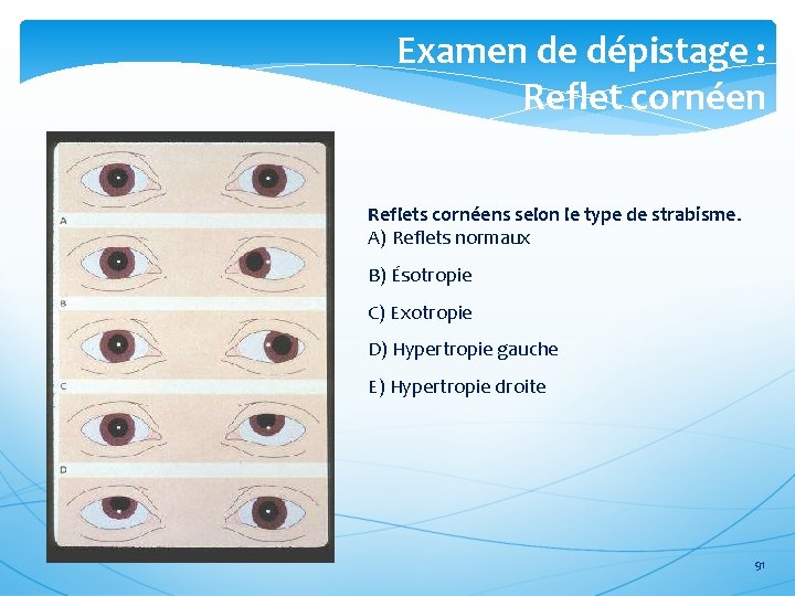 Examen de dépistage : Reflet cornéen Reflets cornéens selon le type de strabisme. A)
