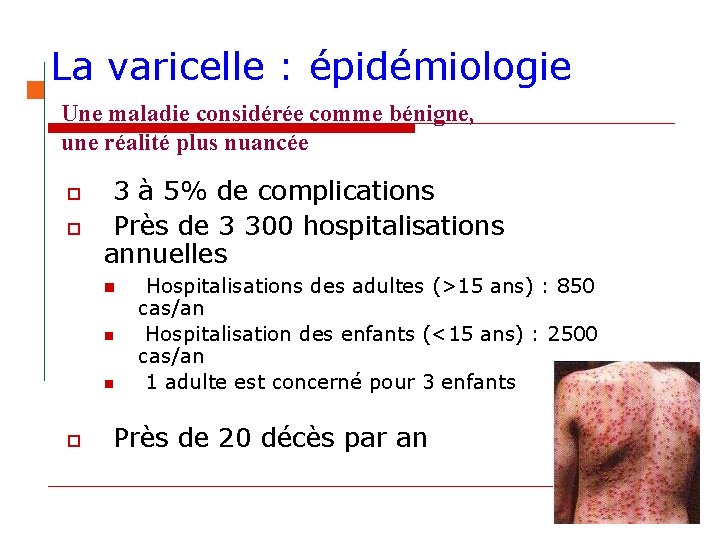 La varicelle : épidémiologie Une maladie considérée comme bénigne, une réalité plus nuancée o