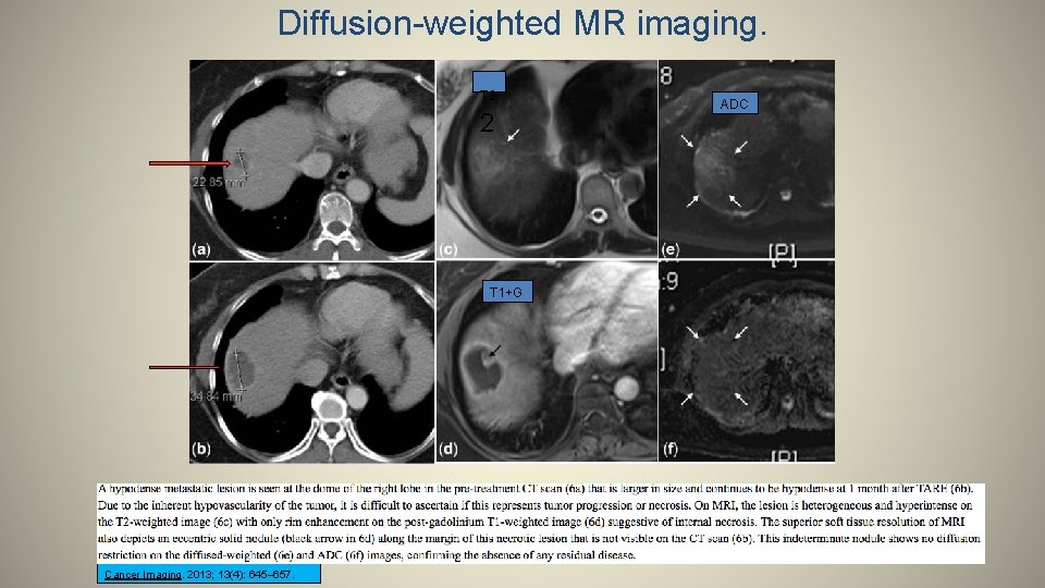 Diffusion-weighted MR imaging. T 2 2 T 1+G Cancer Imaging. 2013; 13(4): 645– 657.