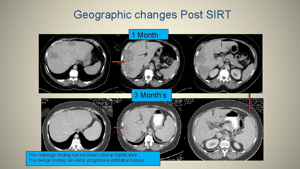 Geographic changes Post SIRT 1 Month 3 Month’s This radiologic finding has no known