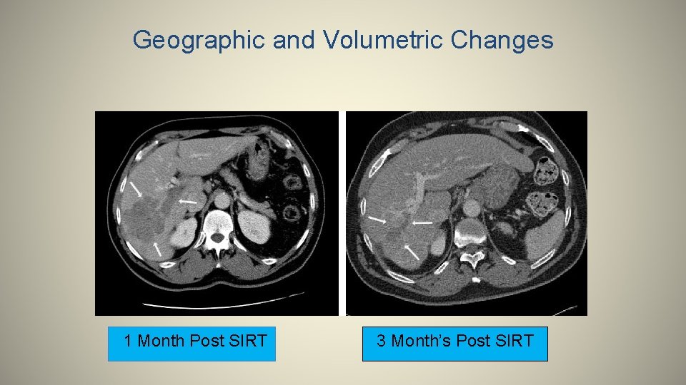 Geographic and Volumetric Changes 1 Month Post SIRT 3 Month’s Post SIRT 