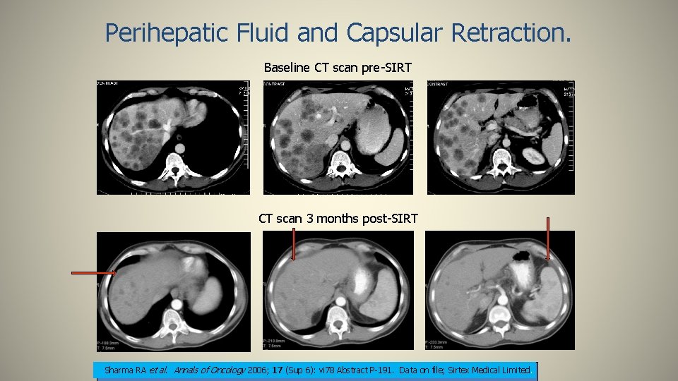 Perihepatic Fluid and Capsular Retraction. Baseline CT scan pre-SIRT CT scan 3 months post-SIRT