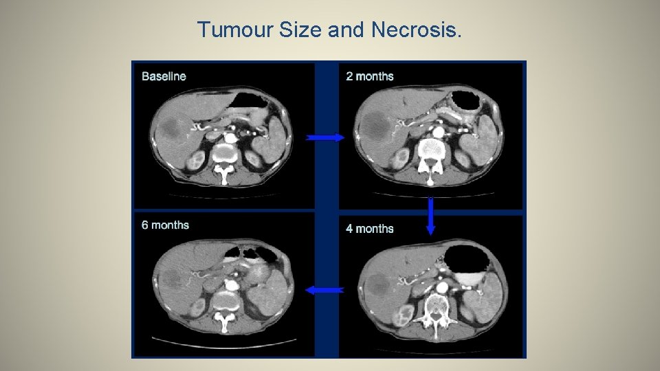 Tumour Size and Necrosis. 