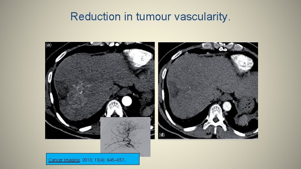 Reduction in tumour vascularity. Cancer Imaging. 2013; 13(4): 645– 657 . 