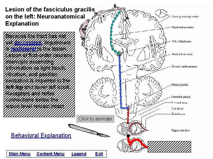 Lesion of the fasciculus gracilis on the left: Neuroanatomical Explanation Because the tract has