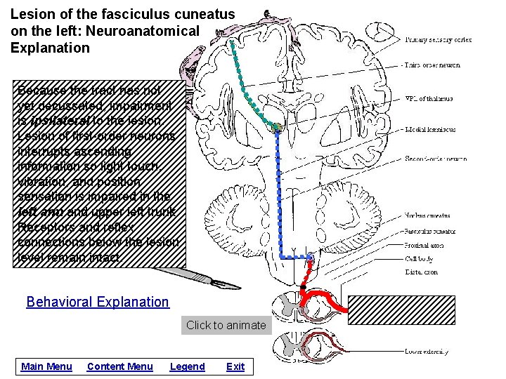 Lesion of the fasciculus cuneatus on the left: Neuroanatomical Explanation Because the tract has