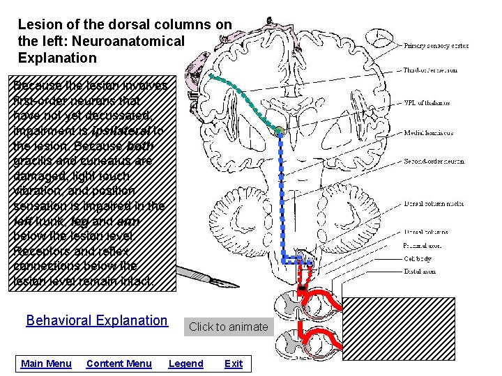Lesion of the dorsal columns on the left: Neuroanatomical Explanation Because the lesion involves