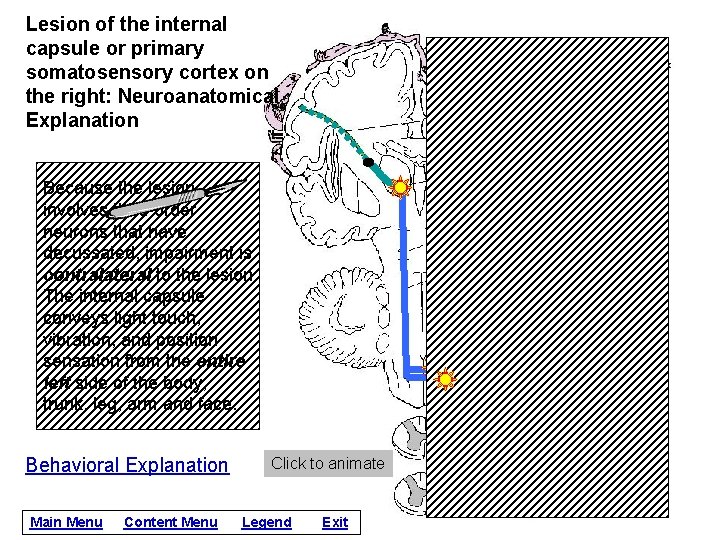 Lesion of the internal capsule or primary somatosensory cortex on the right: Neuroanatomical Explanation