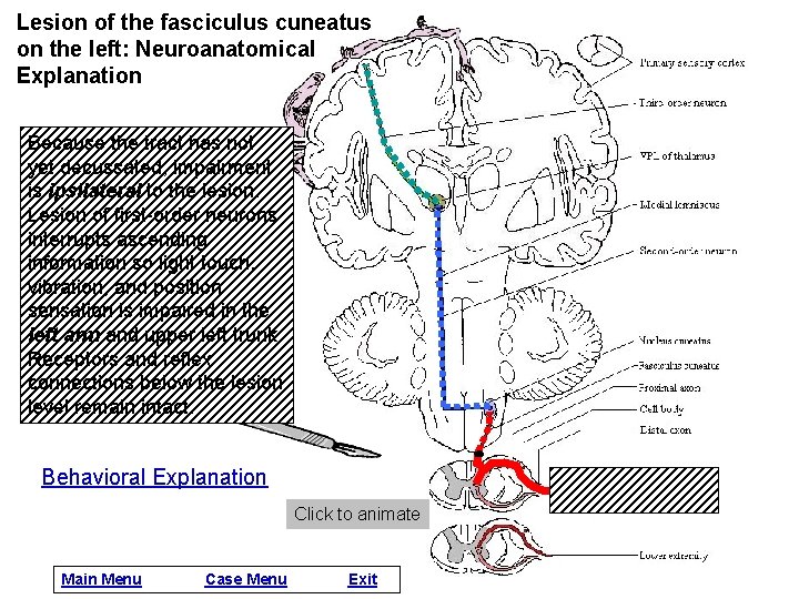 Lesion of the fasciculus cuneatus on the left: Neuroanatomical Explanation Because the tract has