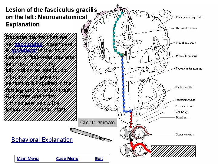 Lesion of the fasciculus gracilis on the left: Neuroanatomical Explanation Because the tract has