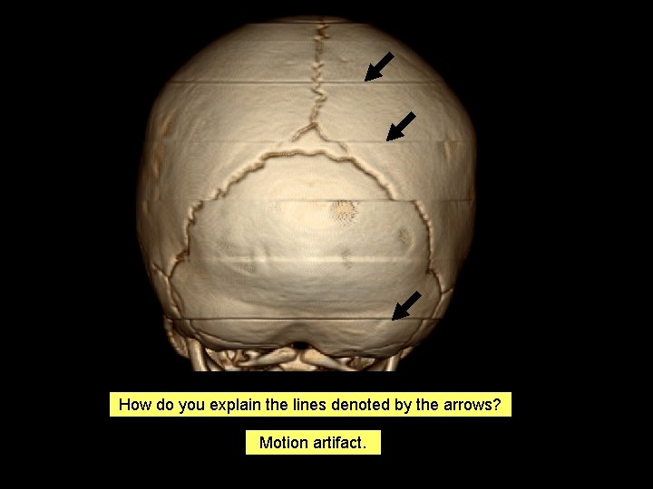 How do you explain the lines denoted by the arrows? Motion artifact. 