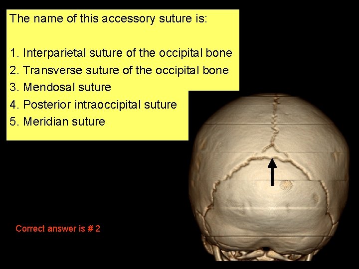 The name of this accessory suture is: 1. Interparietal suture of the occipital bone