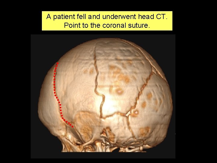 A patient fell and underwent head CT. Point to the coronal suture. 