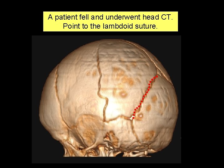 A patient fell and underwent head CT. Point to the lambdoid suture. 