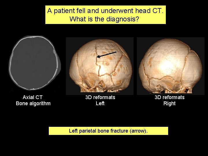 A patient fell and underwent head CT. What is the diagnosis? Axial CT Bone