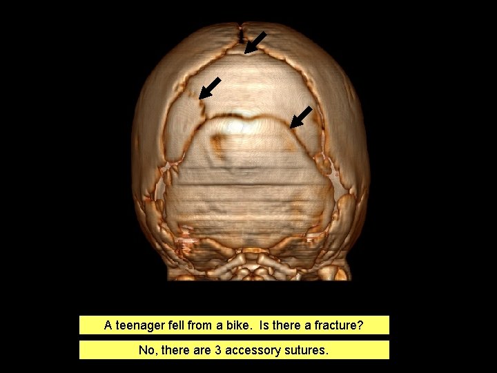 A teenager fell from a bike. Is there a fracture? No, there are 3