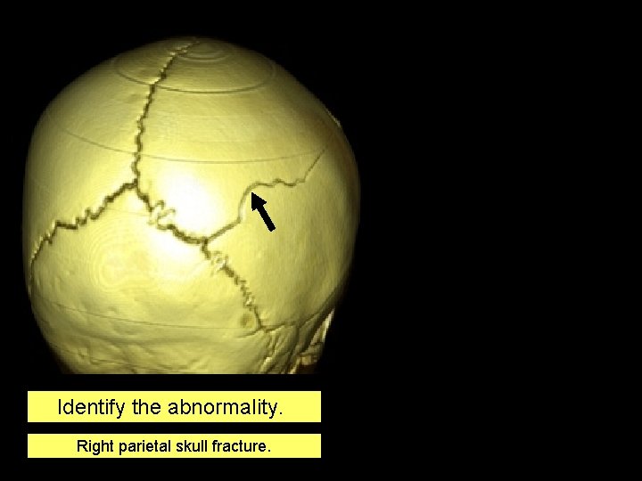 Identify the abnormality. Right parietal skull fracture. 