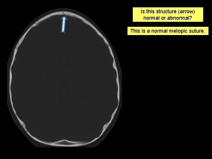 Is this structure (arrow) normal or abnormal? This is a normal metopic suture. 