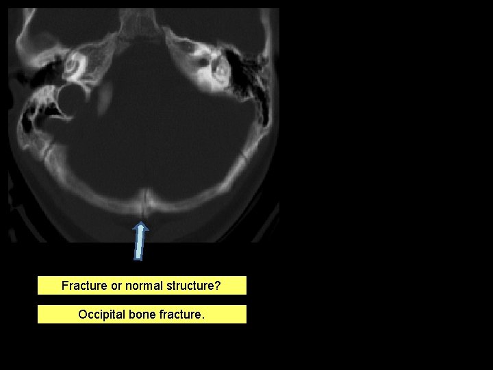 Fracture or normal structure? Occipital bone fracture. 