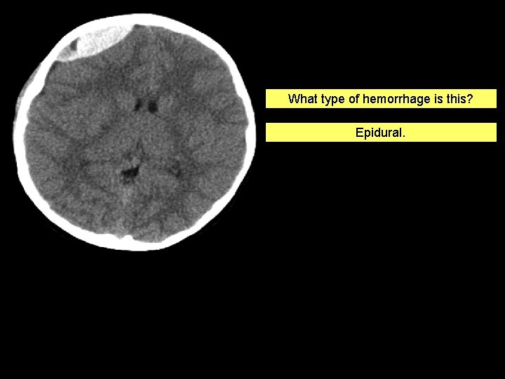 What type of hemorrhage is this? Epidural. 