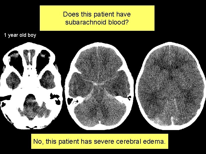 Does this patient have subarachnoid blood? 1 year old boy No, this patient has