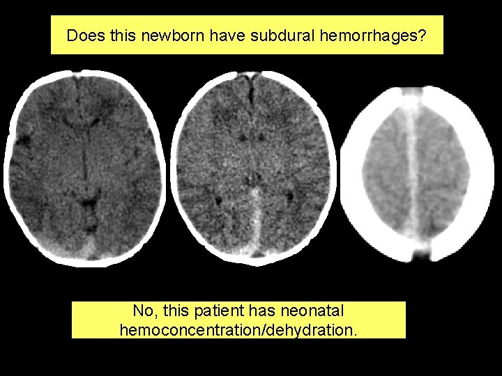 Does this newborn have subdural hemorrhages? No, this patient has neonatal hemoconcentration/dehydration. 