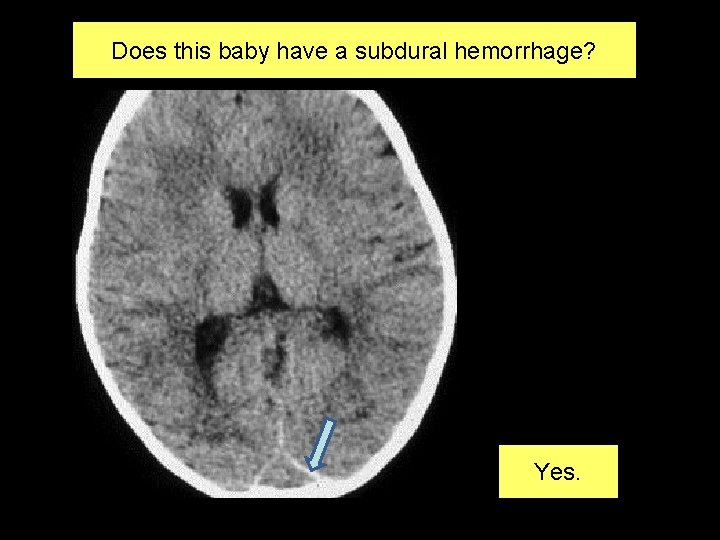 Does this baby have a subdural hemorrhage? Yes. 