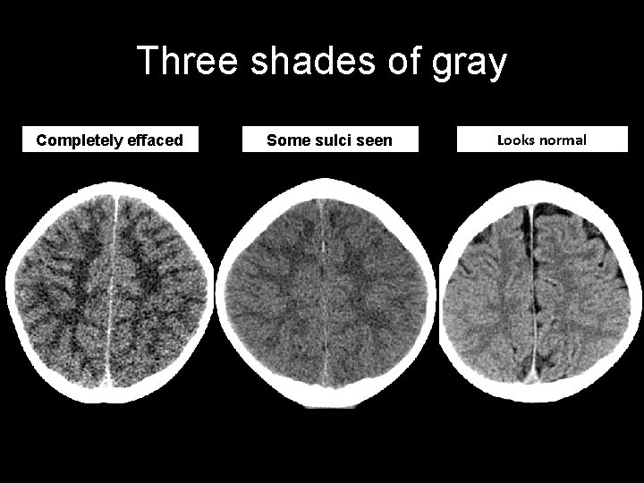 Three shades of gray Completely effaced Some sulci seen Looks normal 