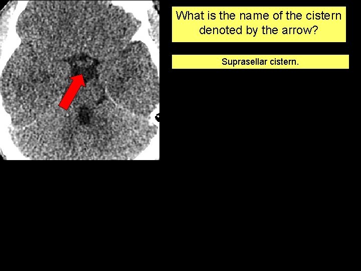 What is the name of the cistern denoted by the arrow? Suprasellar cistern. 