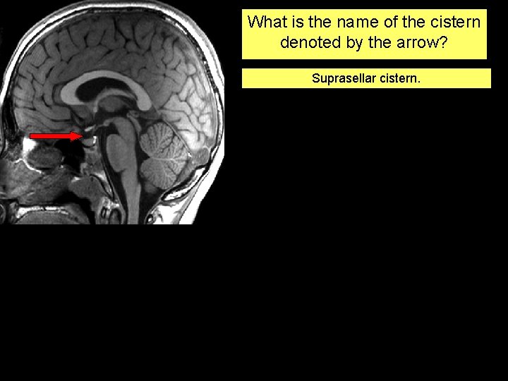 What is the name of the cistern denoted by the arrow? Suprasellar cistern. 