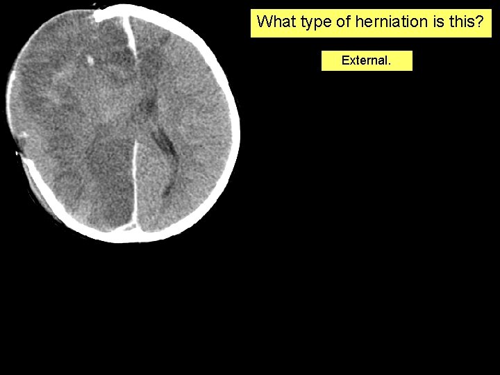 What type of herniation is this? External. 
