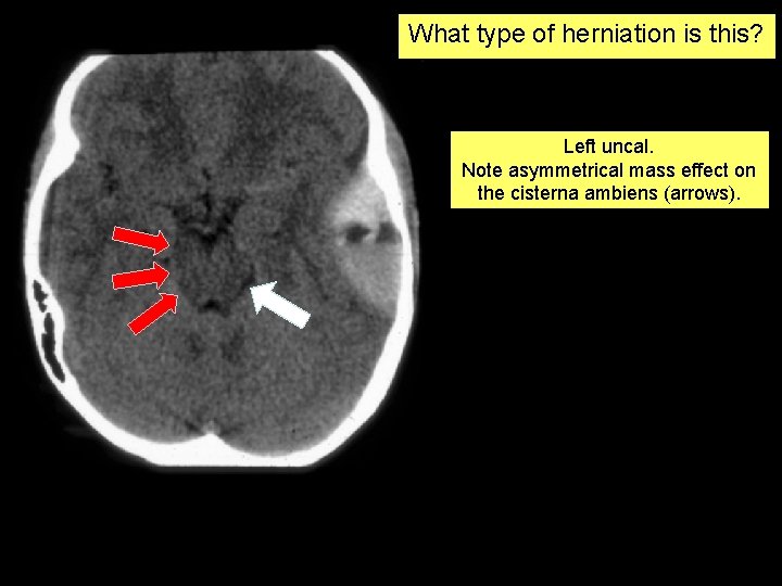 What type of herniation is this? Left uncal. Note asymmetrical mass effect on the