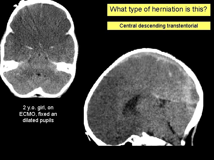 What type of herniation is this? Central descending transtentorial 2 y. o. girl, on