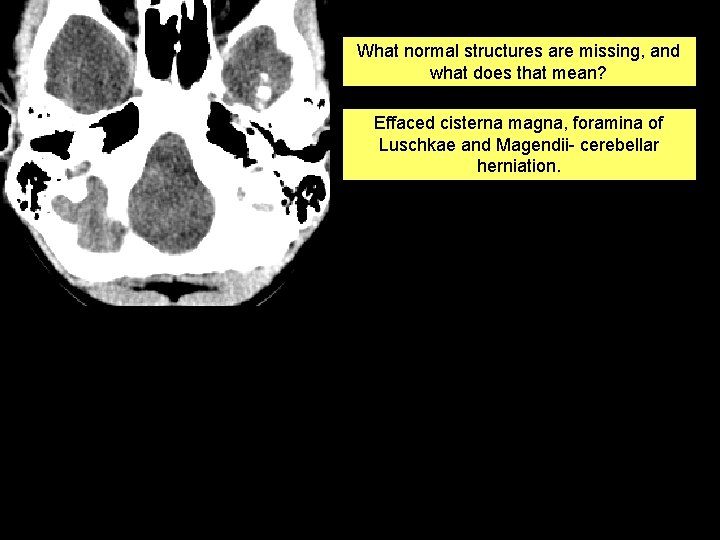 What normal structures are missing, and what does that mean? Effaced cisterna magna, foramina