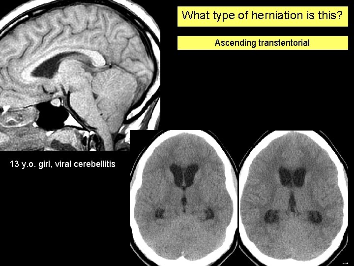 What type of herniation is this? Ascending transtentorial 13 y. o. girl, viral cerebellitis