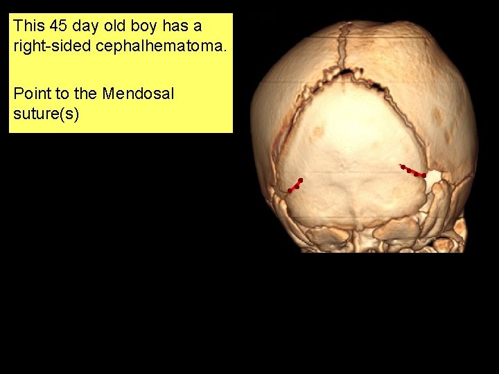 This 45 day old boy has a right-sided cephalhematoma. Point to the Mendosal suture(s)