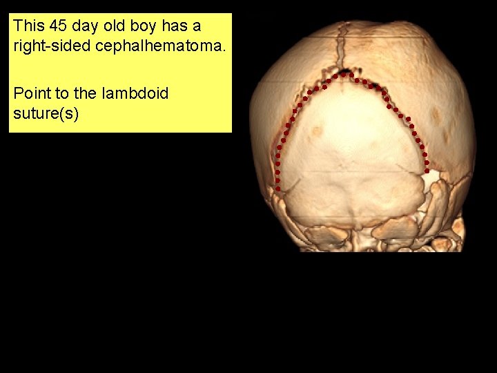 This 45 day old boy has a right-sided cephalhematoma. Point to the lambdoid suture(s)