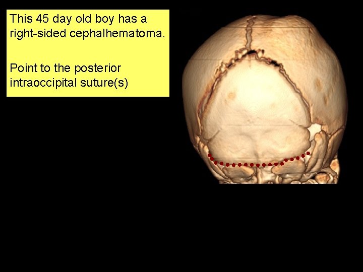 This 45 day old boy has a right-sided cephalhematoma. Point to the posterior intraoccipital