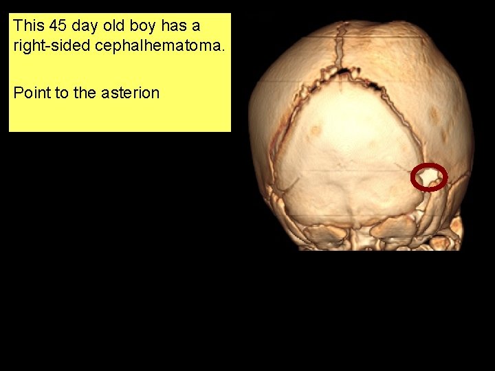 This 45 day old boy has a right-sided cephalhematoma. Point to the asterion 