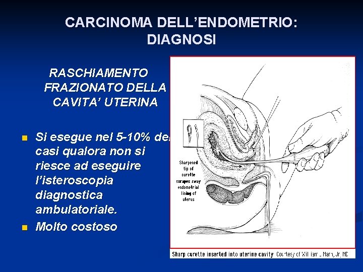 CARCINOMA DELL’ENDOMETRIO: DIAGNOSI RASCHIAMENTO FRAZIONATO DELLA CAVITA’ UTERINA n n Si esegue nel 5