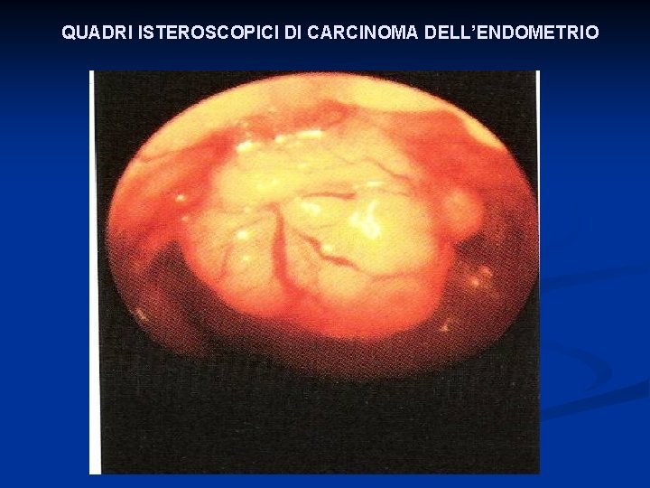 QUADRI ISTEROSCOPICI DI CARCINOMA DELL’ENDOMETRIO 