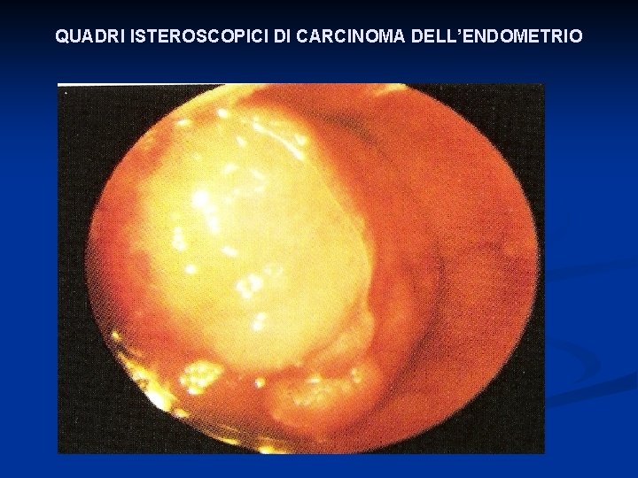 QUADRI ISTEROSCOPICI DI CARCINOMA DELL’ENDOMETRIO 