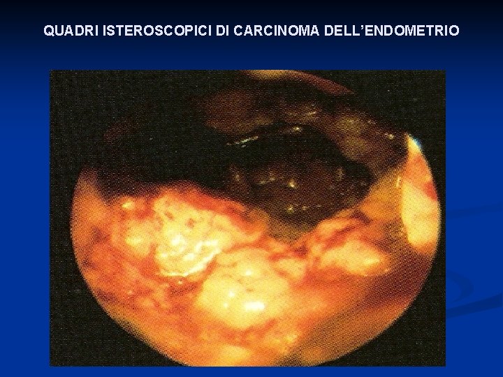 QUADRI ISTEROSCOPICI DI CARCINOMA DELL’ENDOMETRIO 
