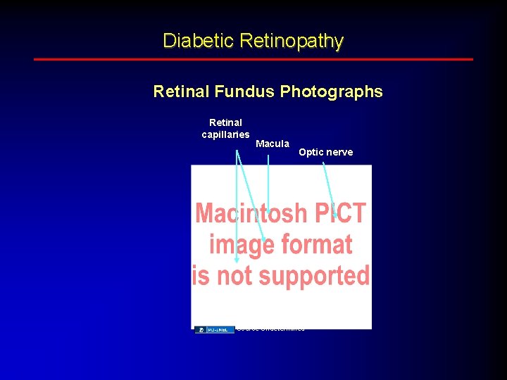 Diabetic Retinopathy Retinal Fundus Photographs Retinal capillaries Macula Optic nerve Source Undetermined 