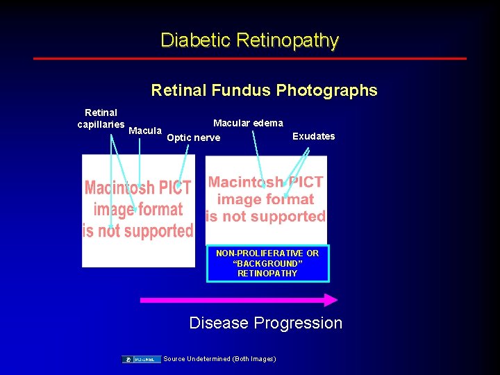 Diabetic Retinopathy Retinal Fundus Photographs Retinal capillaries Macular edema Optic nerve Exudates NON-PROLIFERATIVE OR