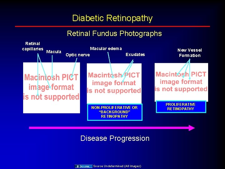 Diabetic Retinopathy Retinal Fundus Photographs Retinal capillaries Macular edema Optic nerve Exudates NON-PROLIFERATIVE OR
