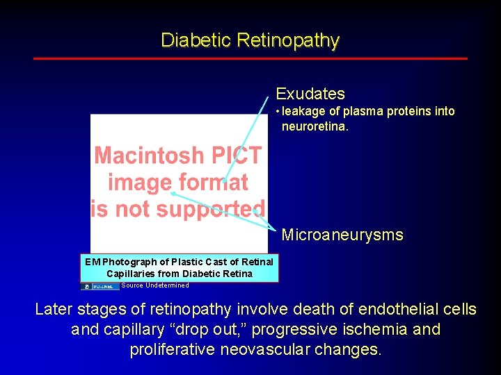 Diabetic Retinopathy Exudates • leakage of plasma proteins into neuroretina. Microaneurysms EM Photograph of
